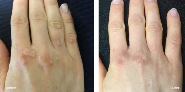 Successful removal of warts after using Rimovio gel review from Andrew 2