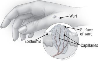 The structure of the warts on the hands