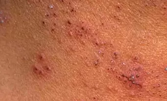 many papillomas on the skin