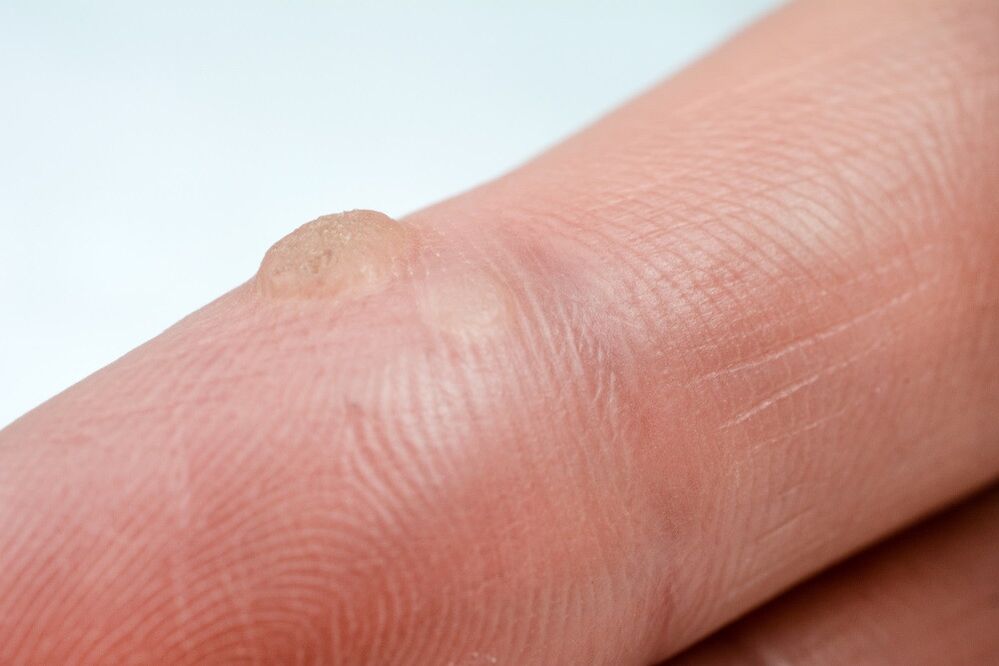 warts
