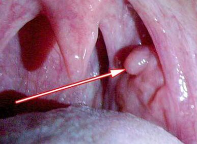 Papillae in the larynx