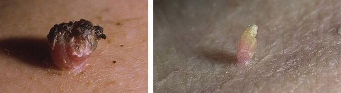 Papillae