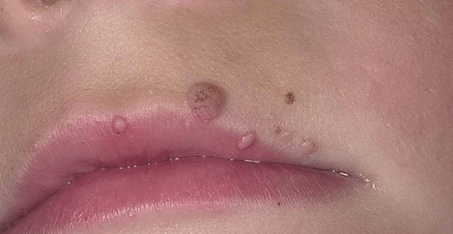 Papillae