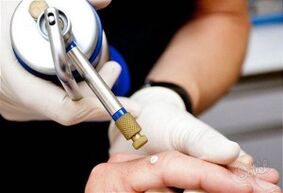method of removing papillomas on the skin