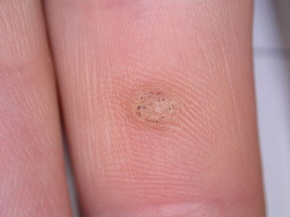 Do warts cause cancer