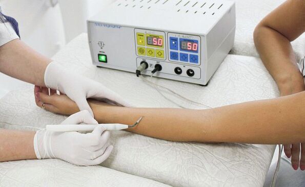 Remove warts using radio waves