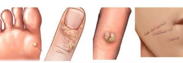 Types of warts on the human body