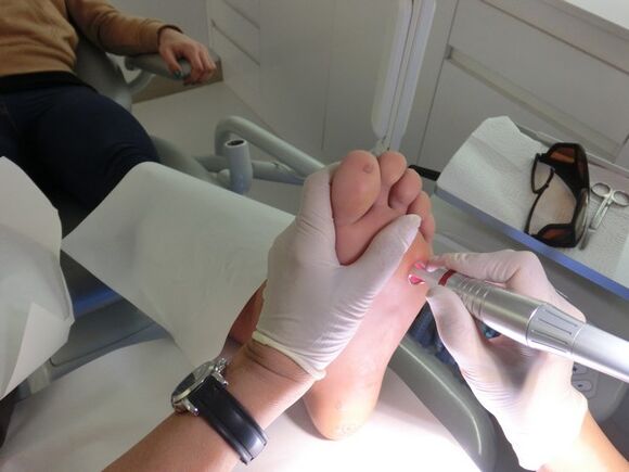 When should warts be removed