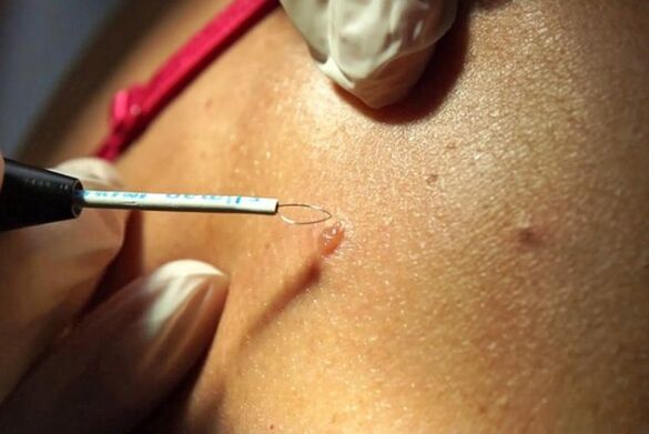 remove warts on the body
