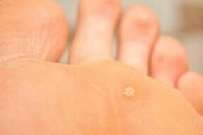 Why do warts appear on the soles of the feet