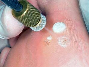cold destruction method as a method of removing warts on the soles of the feet