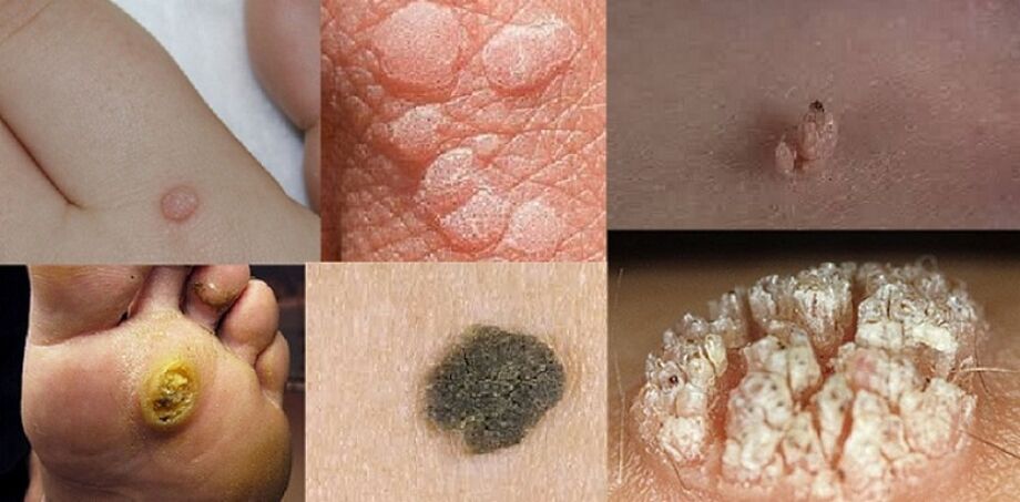Common, flat, fibrous warts, warts, senile warts and genital warts